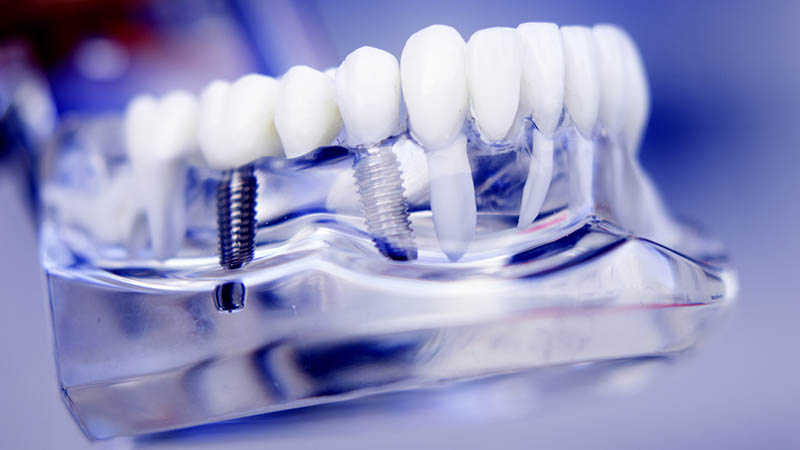 How Long to Dental Implants Last?