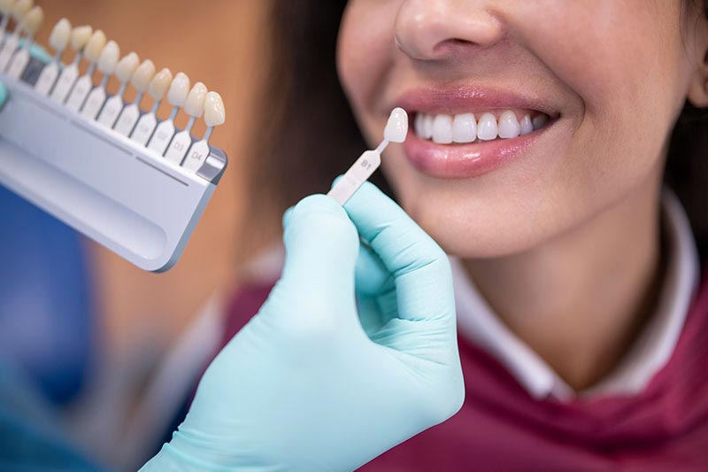 Dental Bonding vs Veneers - What's The Difference?